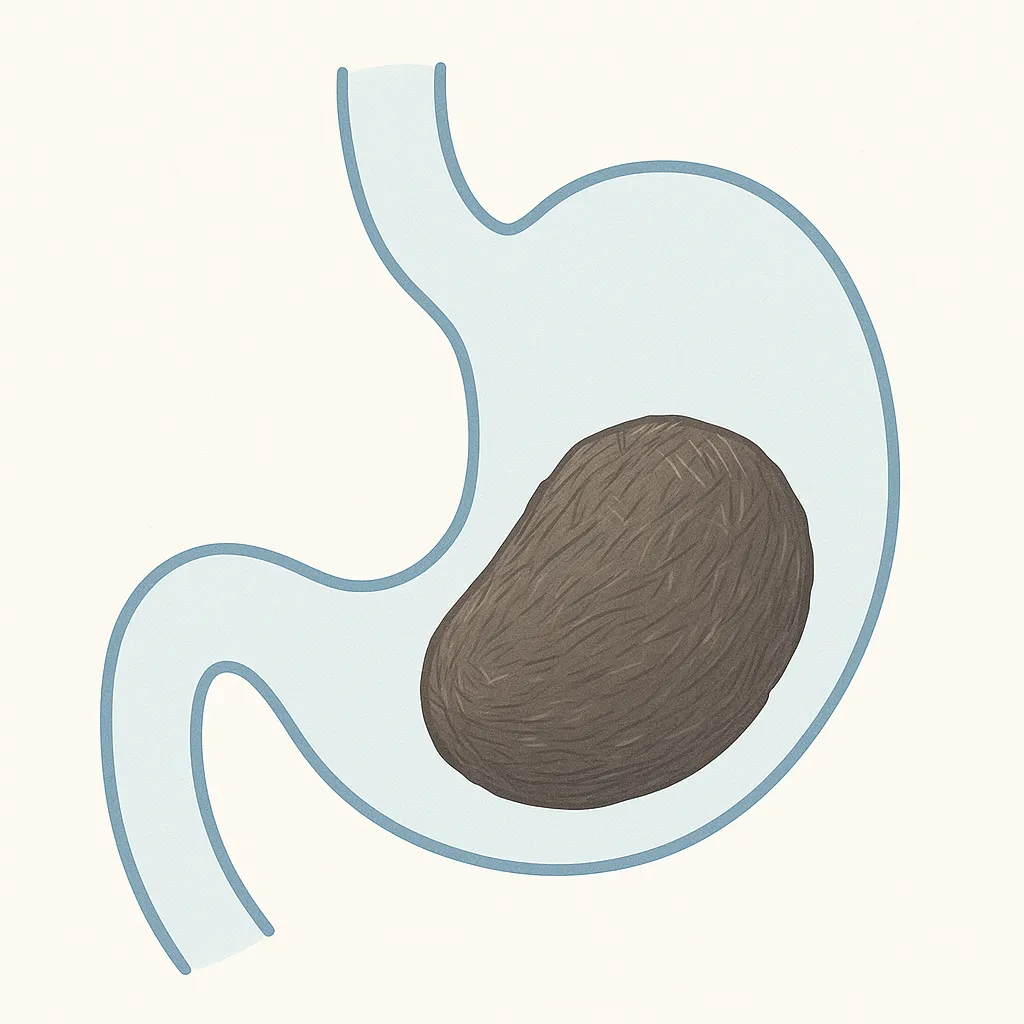 Medical illustration of a phytobezoar (stomach stone) formed from persimmon fibers inside a human stomach.